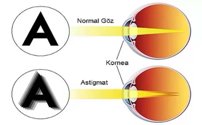 astigmat